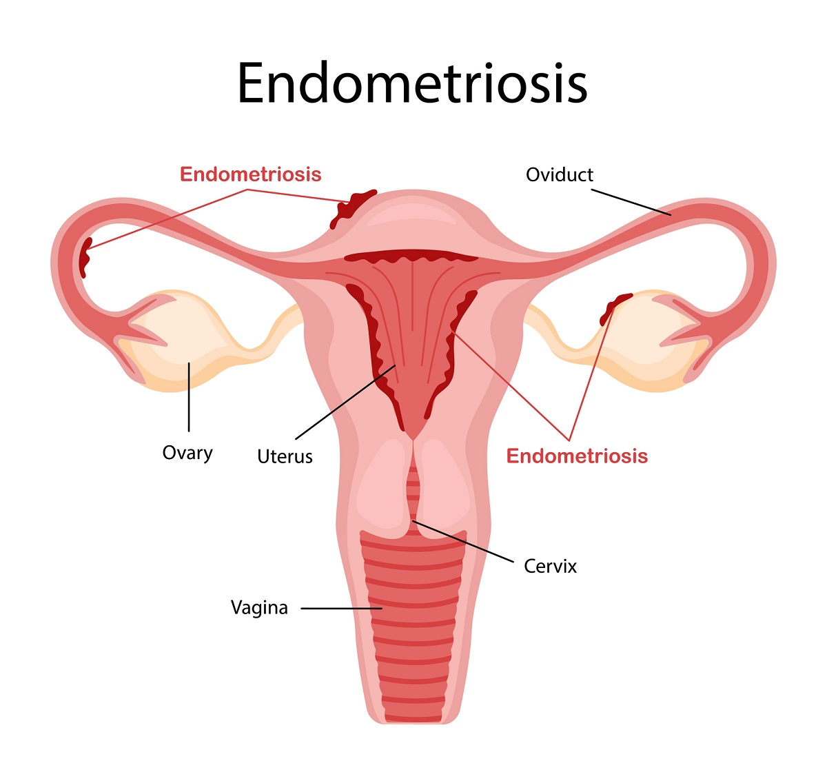 Endometrióza a její výskyt mimo dělohu. Zdroj fotografií: Getty Images. Endometrióza a výskyt endometria mimo děložní dutinu